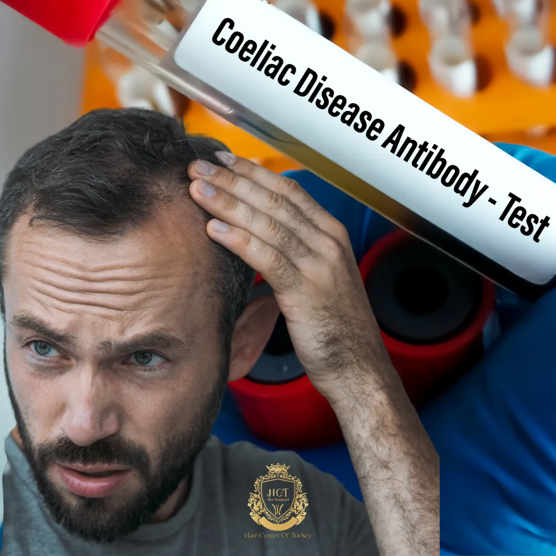 The Link Between Coeliac Disease and Hair Loss 1 coeliac disease and hair loss