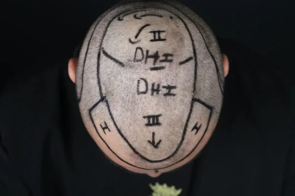 Queda de cabelo coroa: causas, tratamentos e prevenção