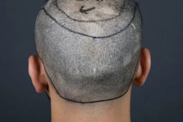 Haartransplantation am Oberkopf: Was ist das und warum ist es wichtig?