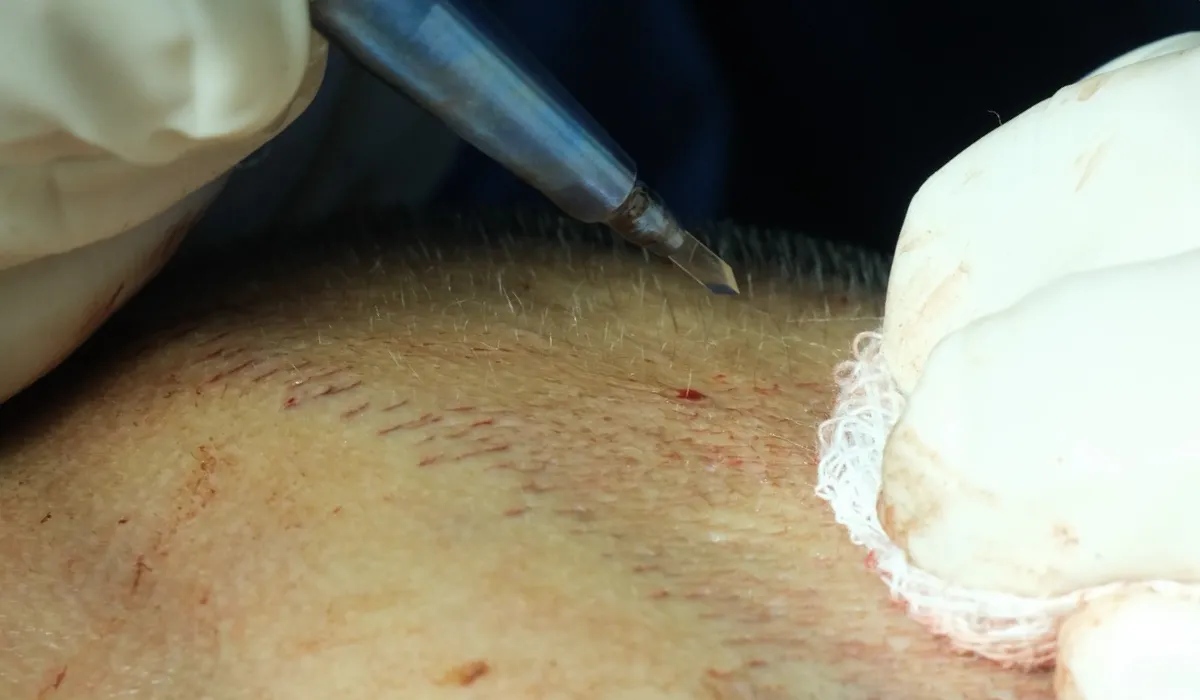 david-silva-Haartransplantatie-6 david-silva-Haartransplantatie-6