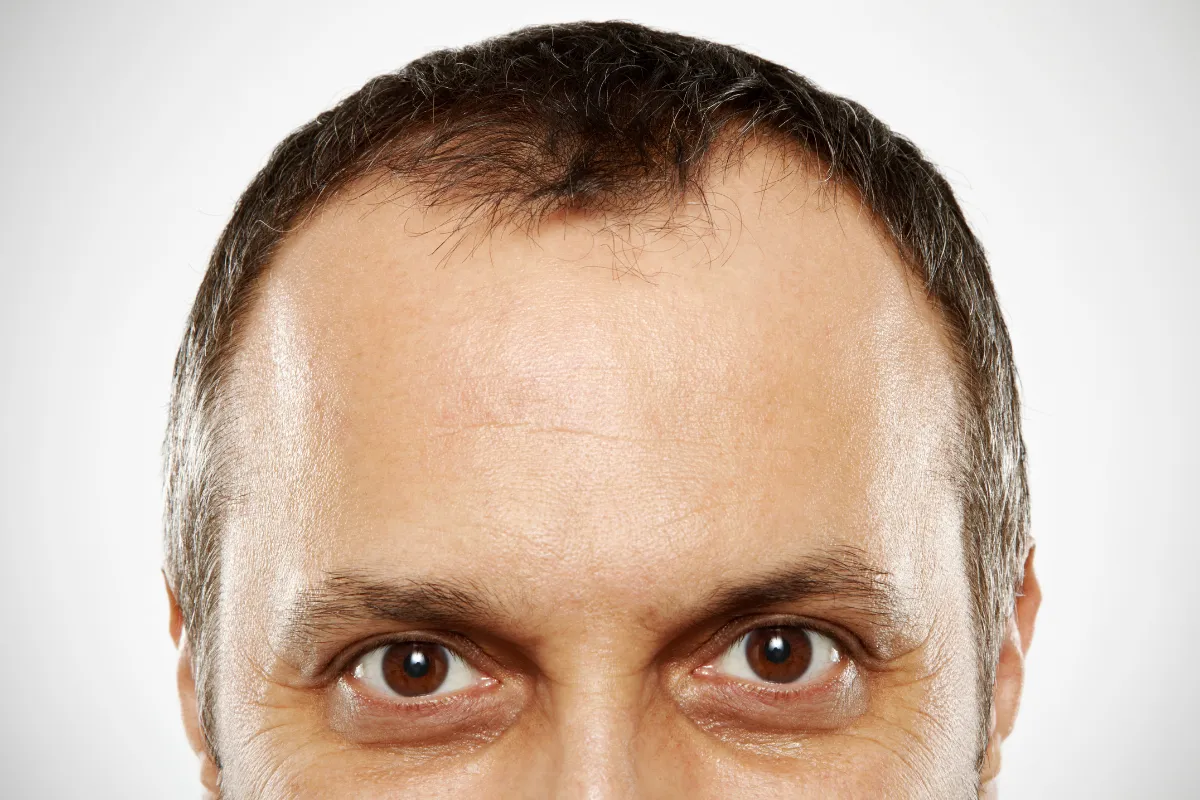 verschiedene-Haarlinien-Typen-2