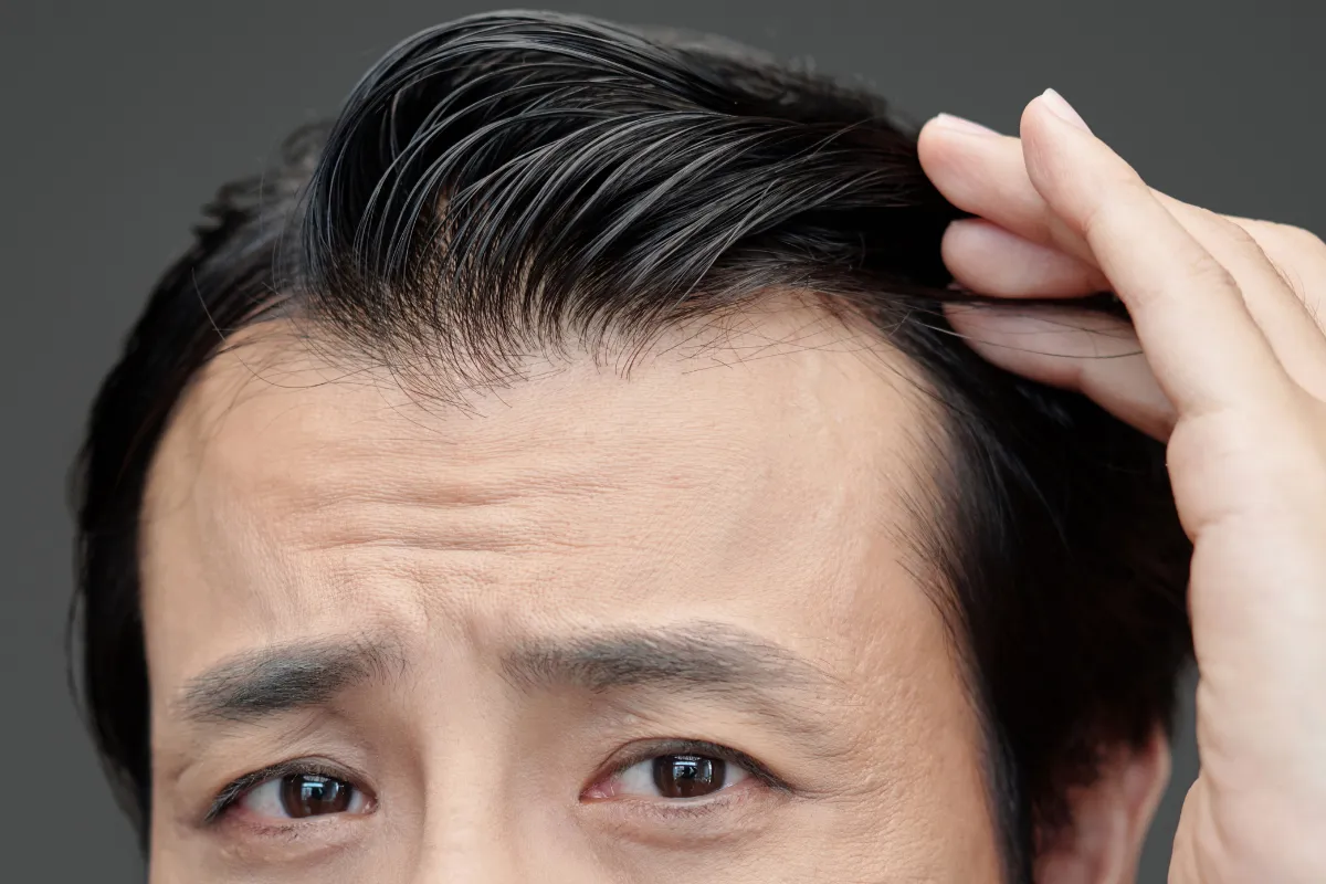 verschiedene Haarlinienarten (3)