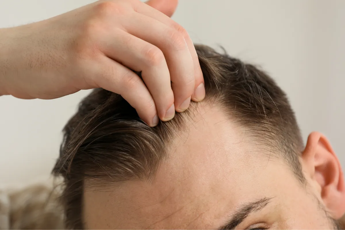 verschiedene Haarlinienarten (5)