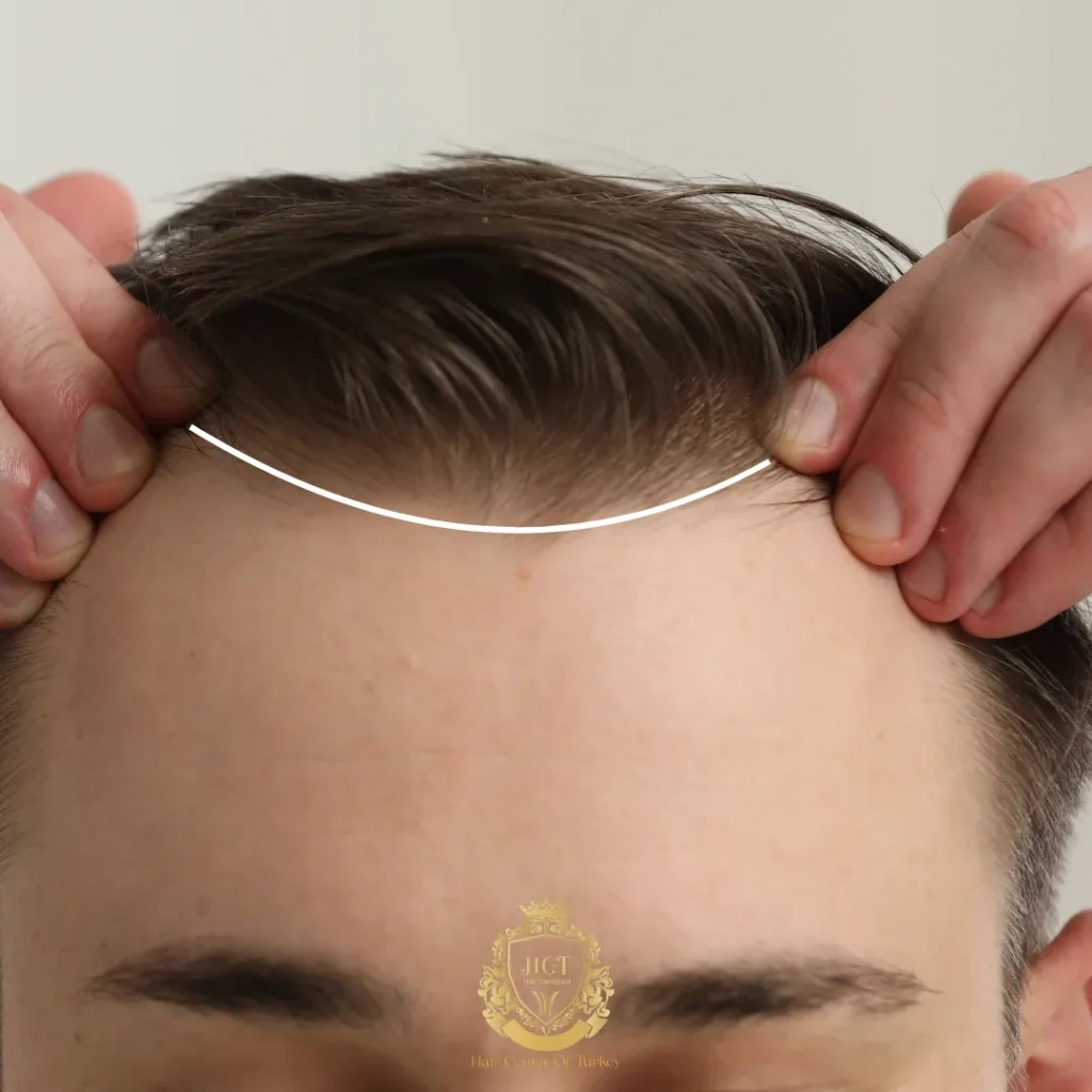 Différents types de lignes de cheveux