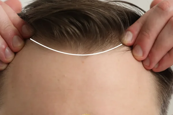 Verschiedene Haaransatztypen