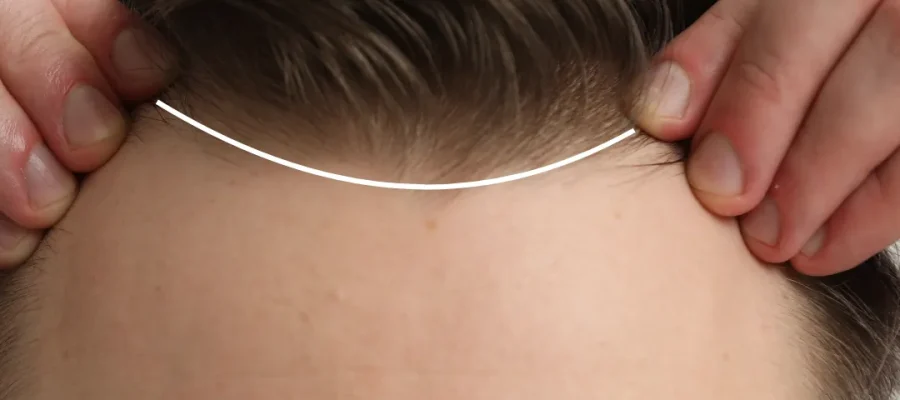 Diferentes tipos de líneas capilares