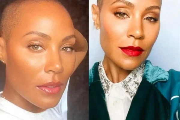 Celebridades femininas que lidam com a queda de cabelo