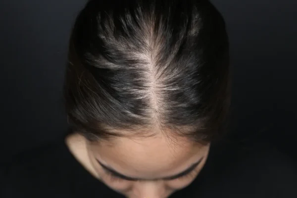 Entendendo a Calvície Feminina aos 20 Anos