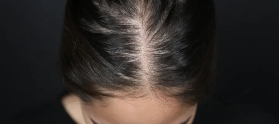 vrouwelijke patroonhaaruitval 20s fi2