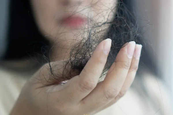 Alopecia fibrosante frontal (AFF)