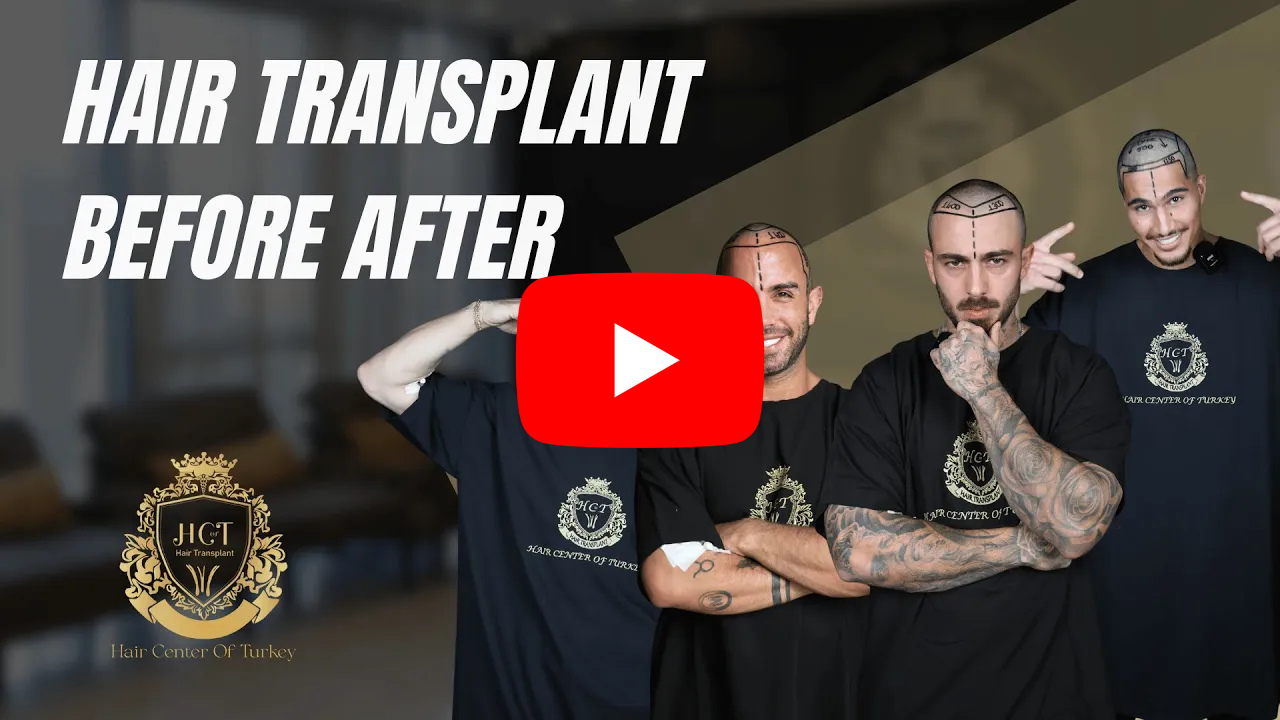 mpcopy 21 hair transplant before after videos th