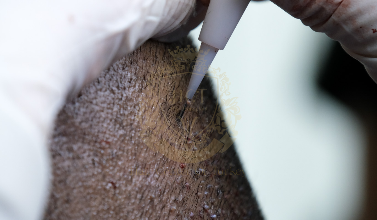 hair transplant techniques used at hair center of turkey receding hairline