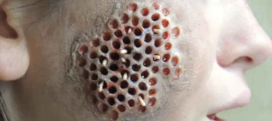 hair transplant trypophobia