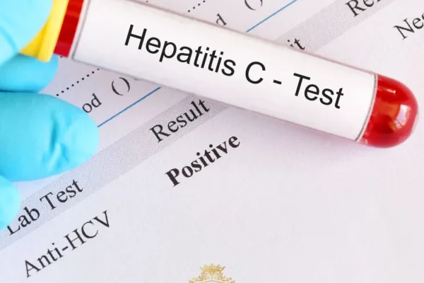 Can Patients with Hepatitis C Have Hair Transplant Done?