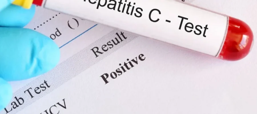 Kunnen patiënten met hepatitis C een haartransplantatie laten doen?