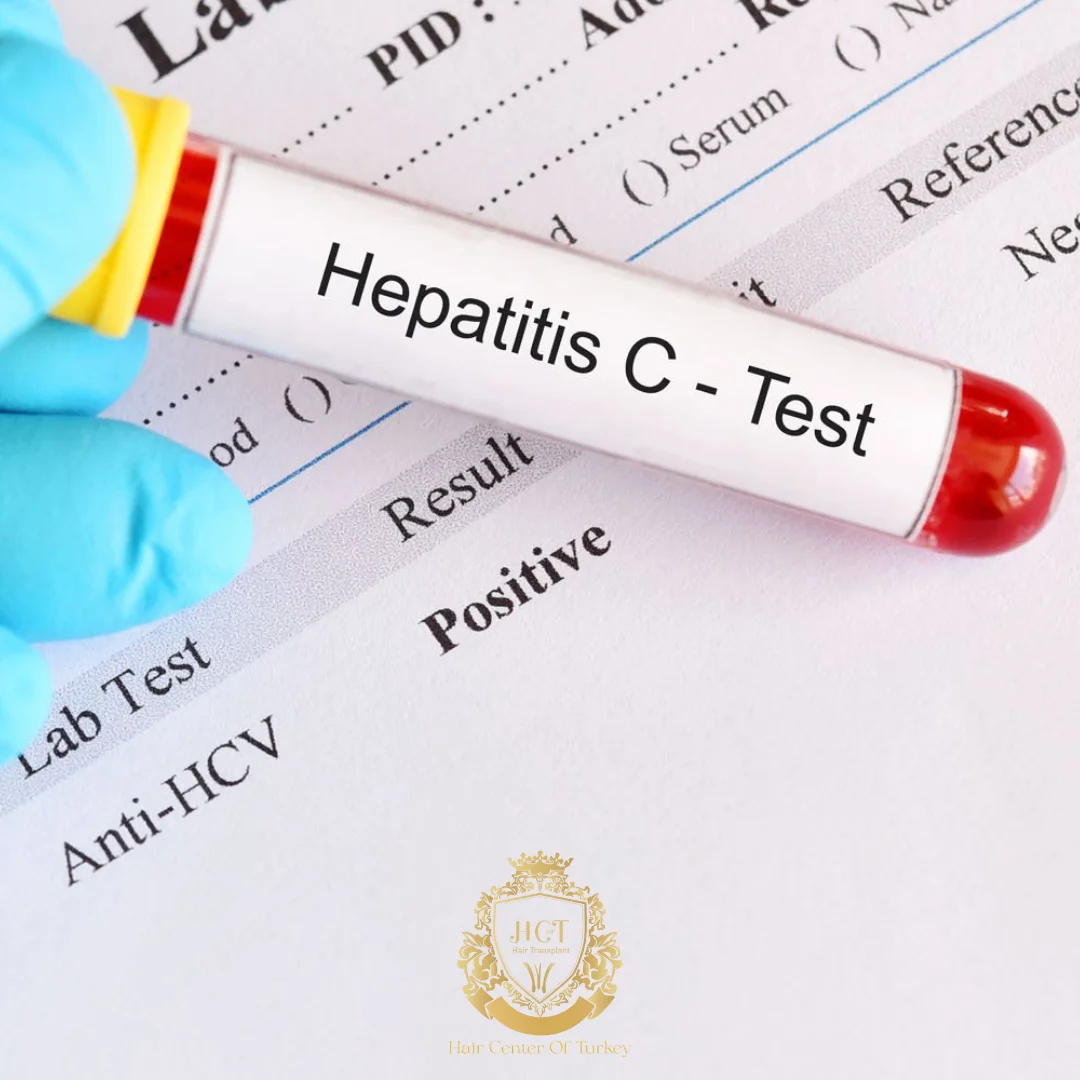 Kunnen patiënten met hepatitis C een haartransplantatie laten doen?