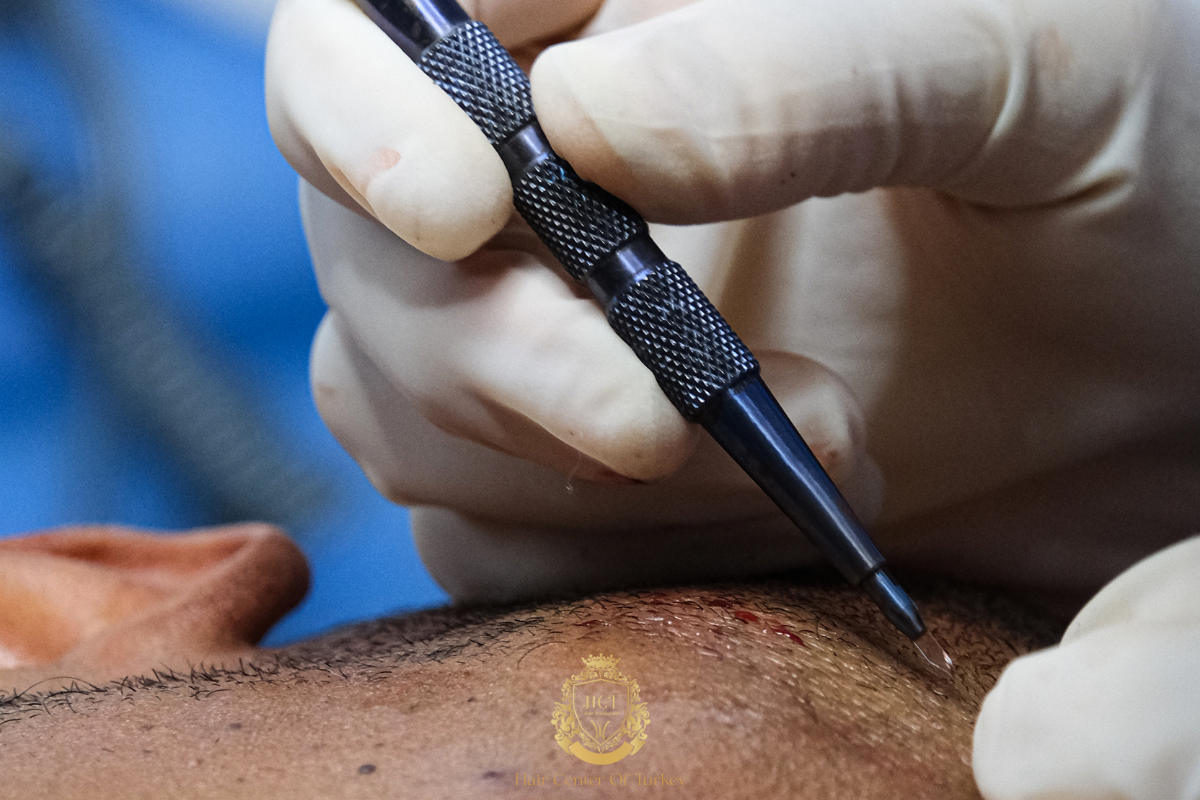 how does work neo hair transplant receding hairline