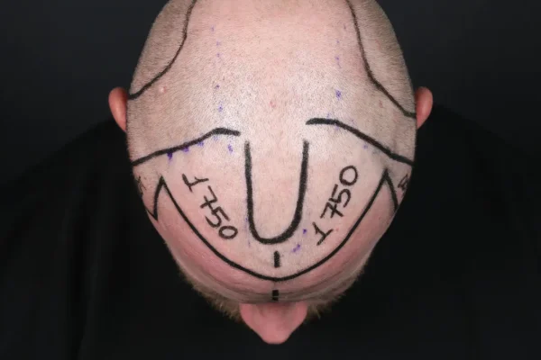 Was kostet eine Haartransplantation mit 3500 Grafts?