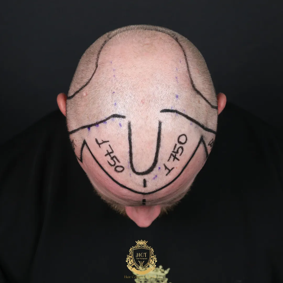 Hoeveel kost een haartransplantatie van 3500 grafts?