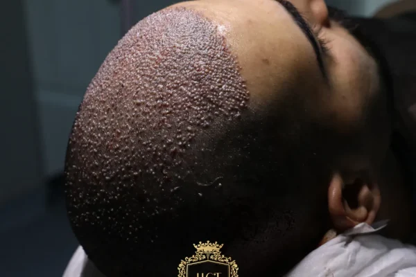 Was kostet eine Haartransplantation mit 5000 Grafts?