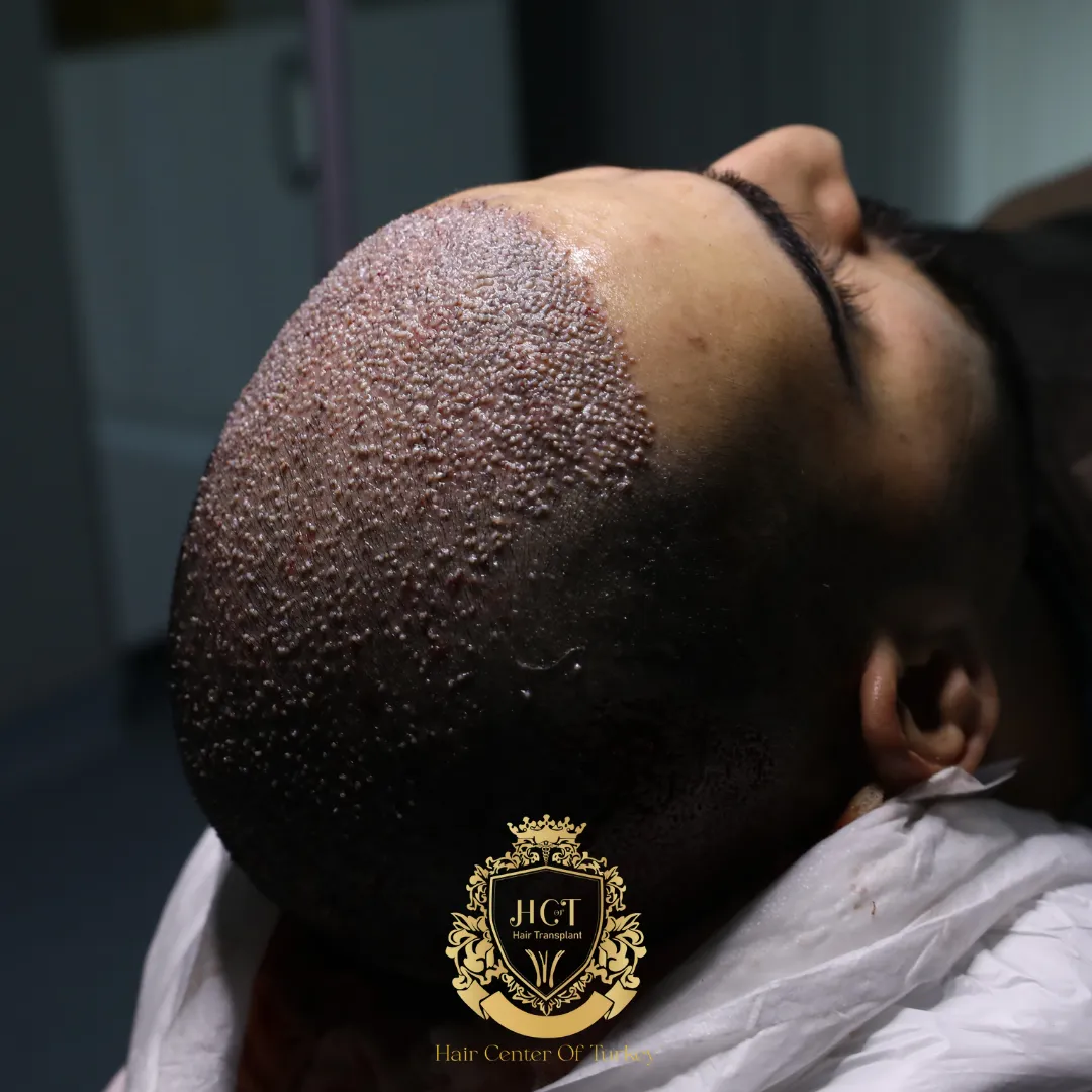 ¿Cuánto cuesta un trasplante capilar de 5000 injertos?