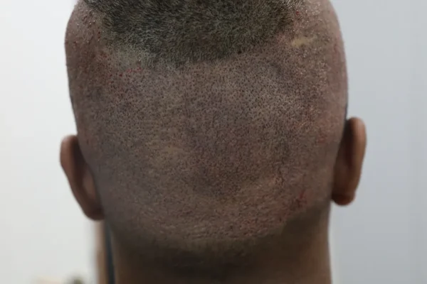 Como lidar com a tripofobia após transplante capilar?