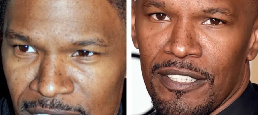 jamie foxx hair transplant