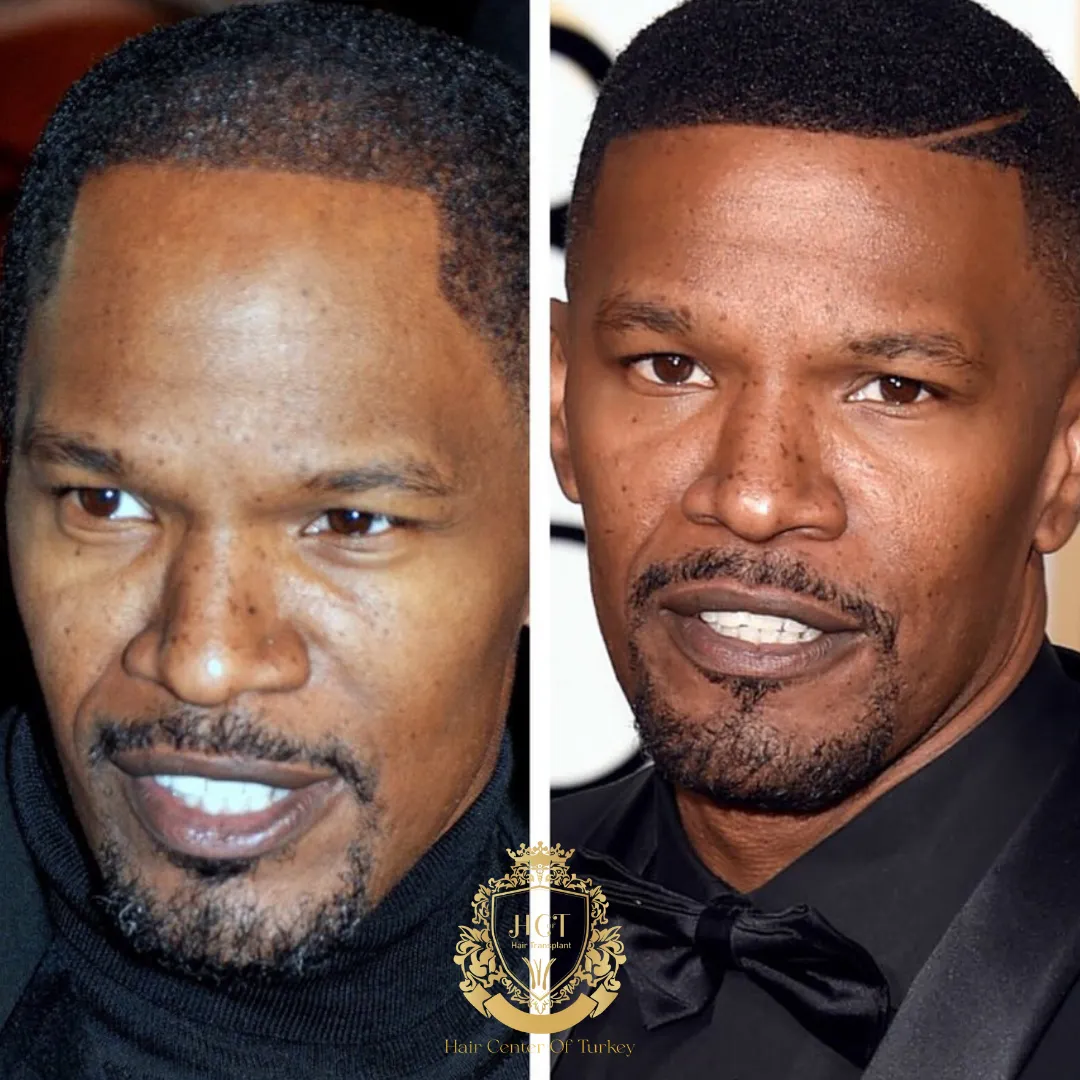 Jamie Foxx Saç Ekimi: Yaptırdı mı? 1 jamie foxx hair transplant