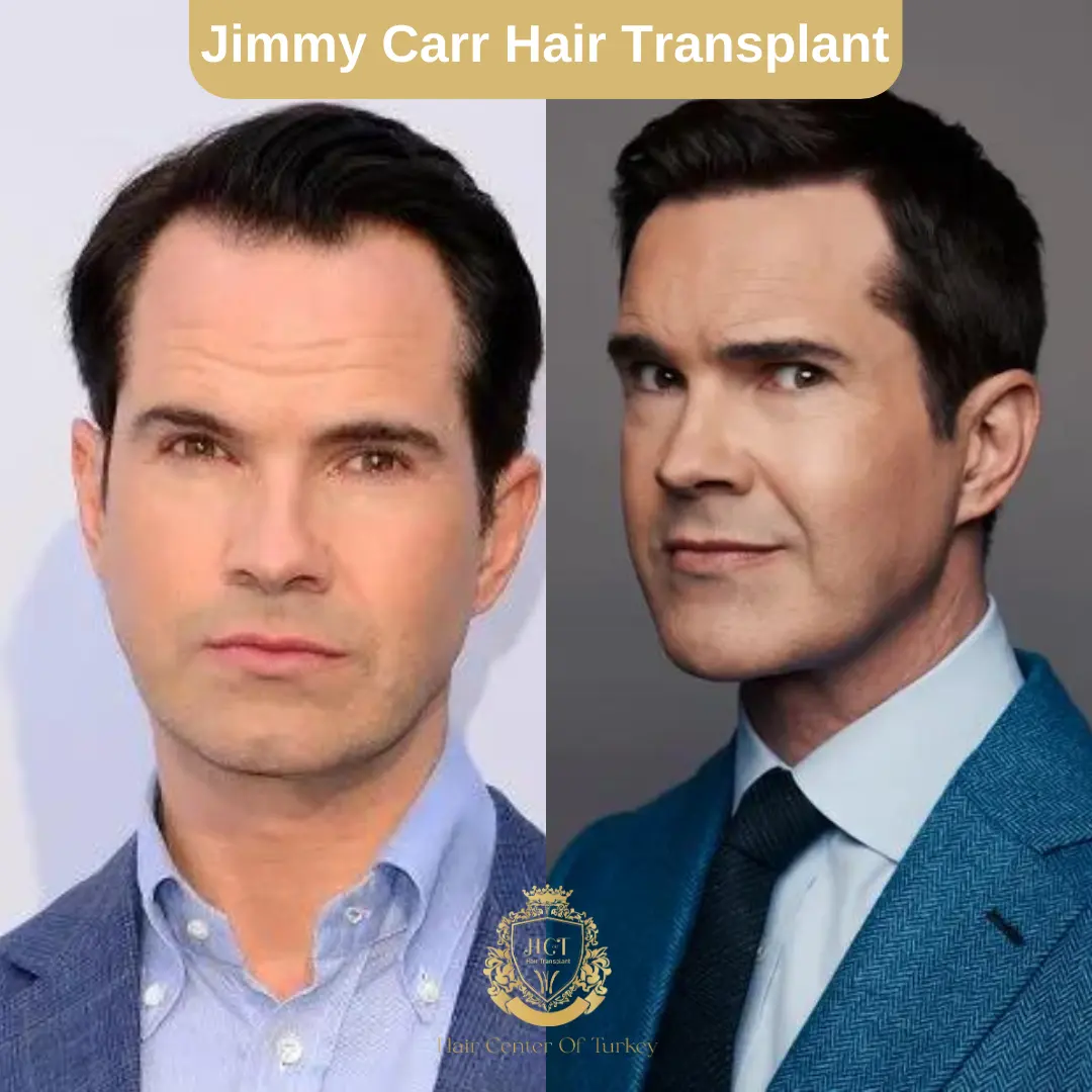 Jimmy Carr Haartransplantation: Welche Technik Wurde Verwendet?