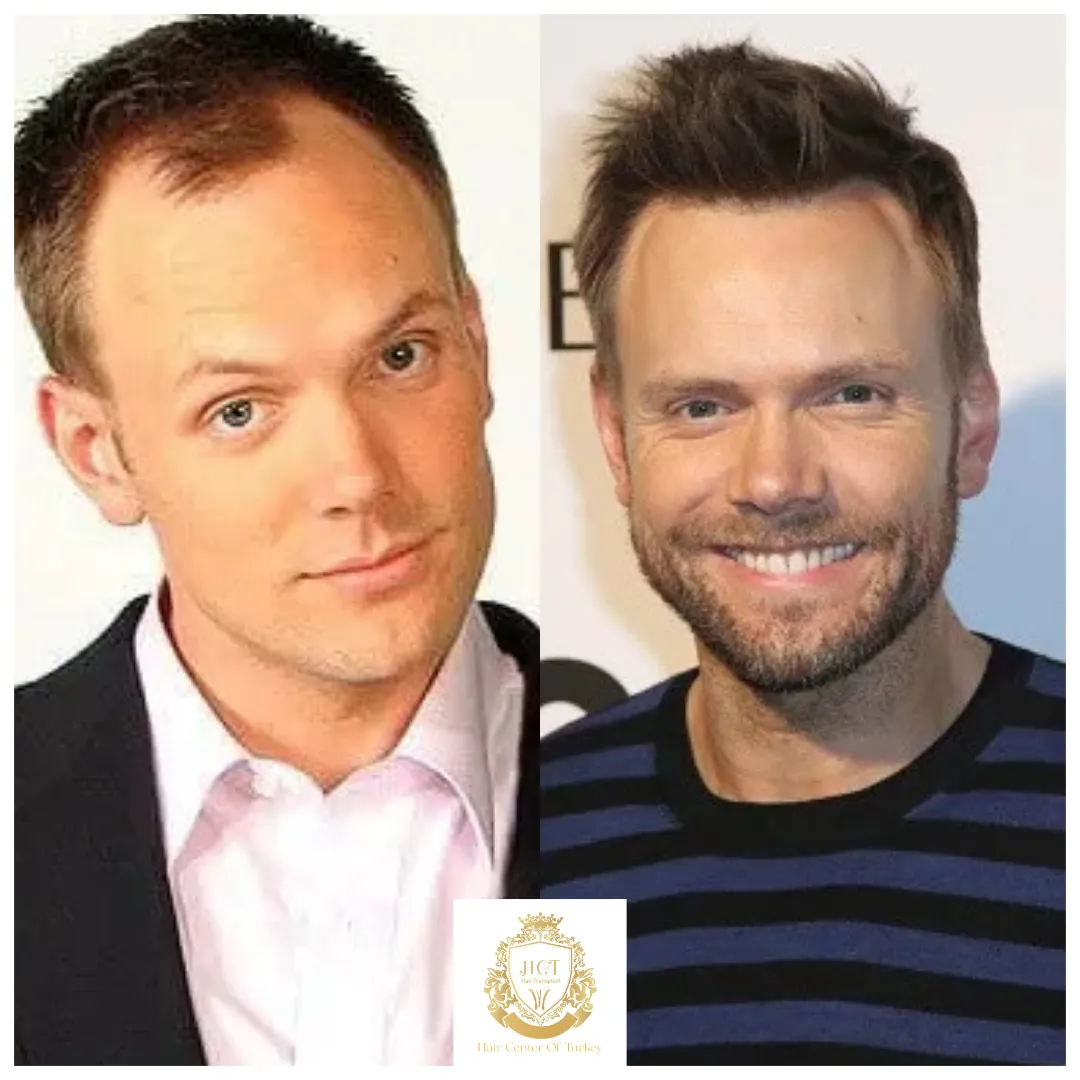 joel mchale hair transplant