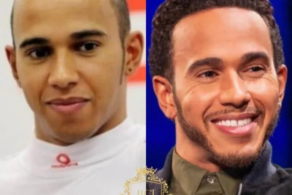 Gerüchte Über Eine Haartransplantation Bei Lewis Hamilton: Was Wir Wissen (Und Was Nicht Bestätigt Ist)