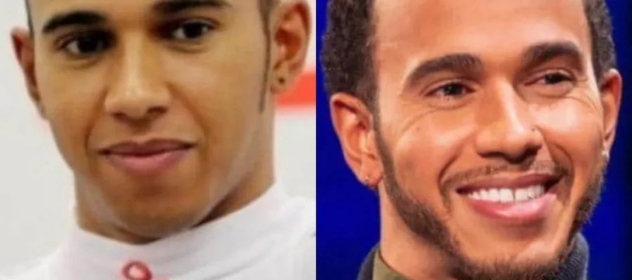 lewis hamilton hair transplant