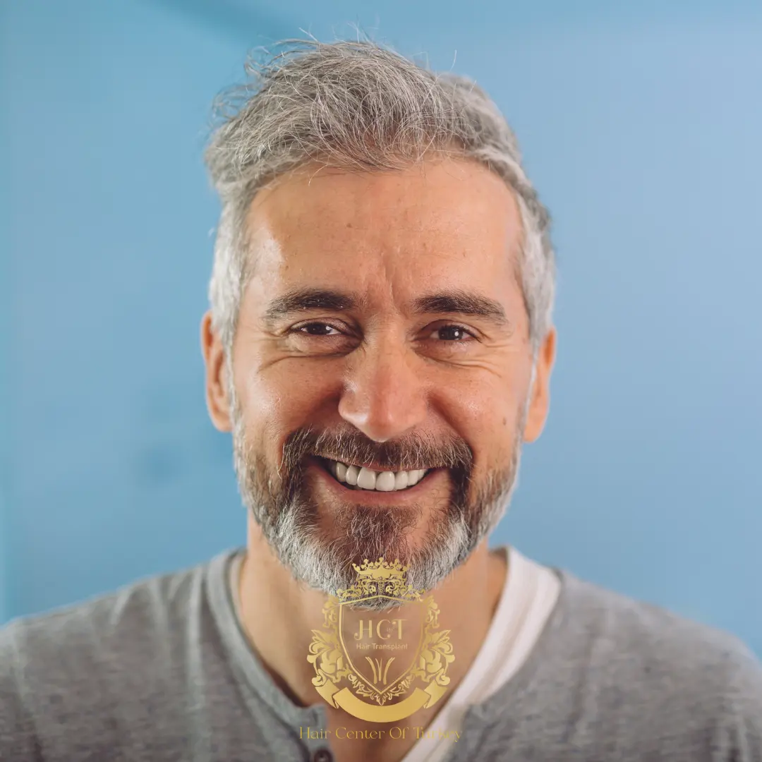 Síndrome De María Antonieta (Canicie Súbita): Causas, Síntomas Y Qué Ocurre Realmente