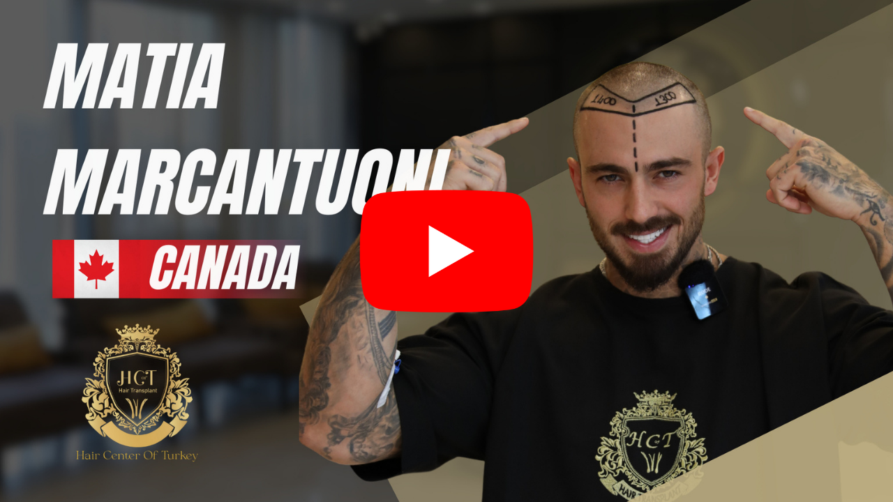 mpcopy 27 matia marcantuoni hair transplant journey th