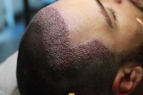 Neo Hair Transplant Guide