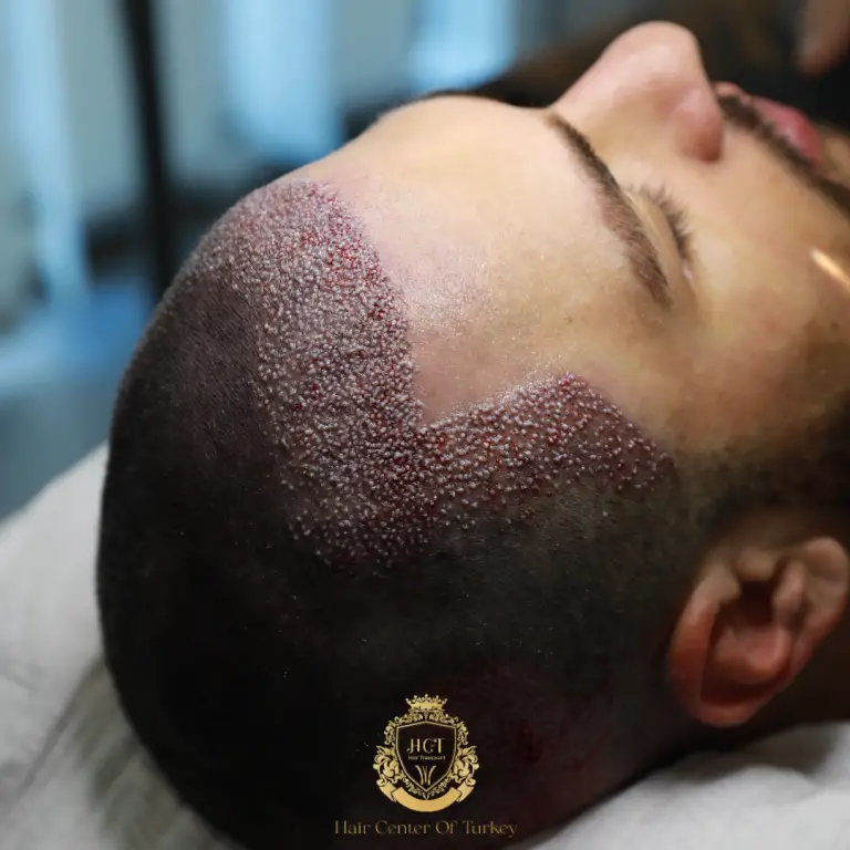 Neo Hair Transplant Guide