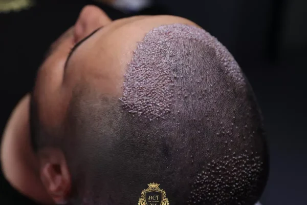 Post-Hair Transplant Hair Care: Critical Steps For Successful Results