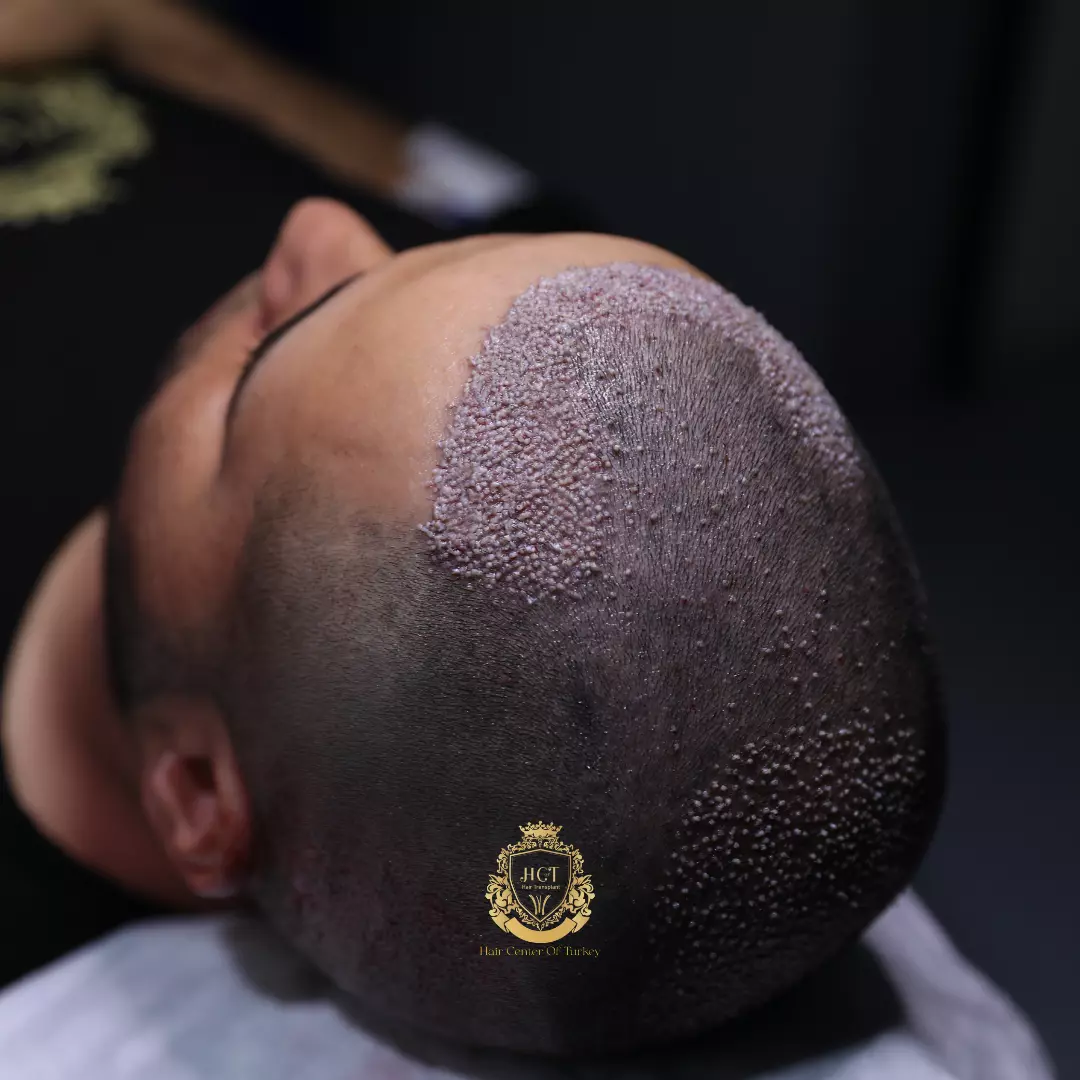 Post-Hair Transplant Hair Care: Critical Steps For Successful Results