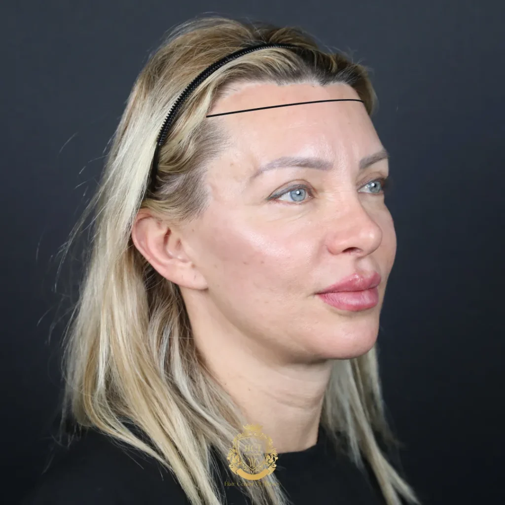 recul de la ligne des cheveux chez la femme