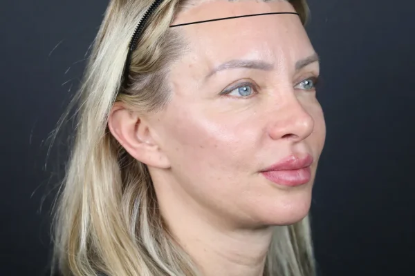 Recuo da linha do cabelo em mulheres