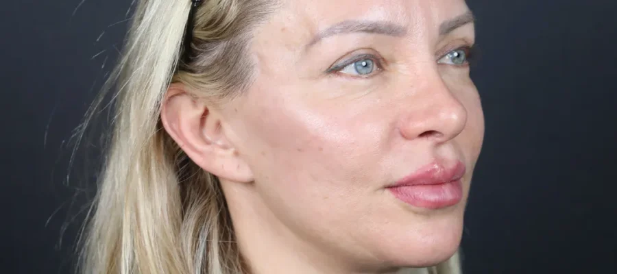 terugtrekkende haarlijn bij vrouwen