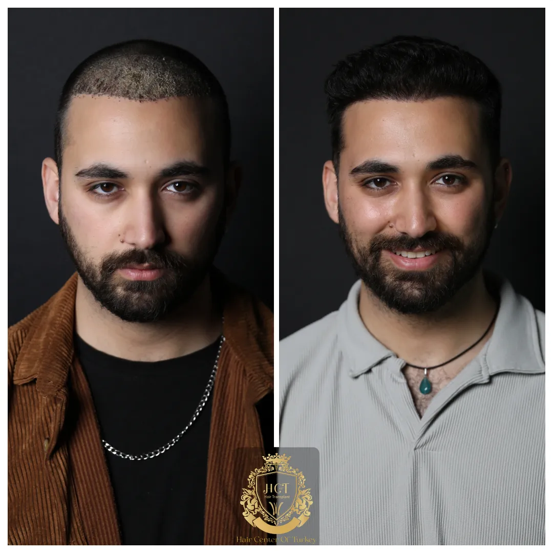 Recovery Process After Hair Transplant 1 Recovery Process After Hair Transplant