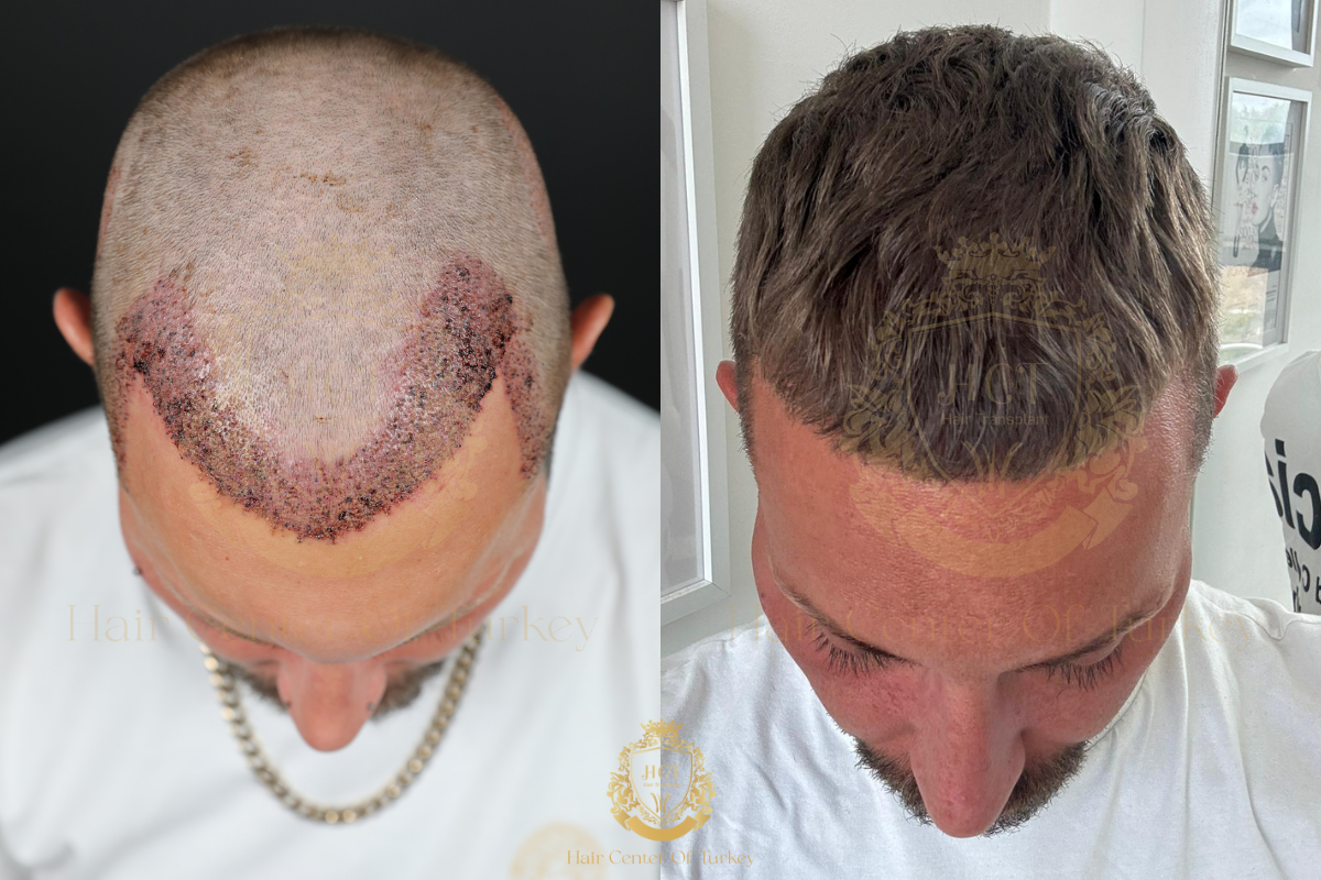 recovery process neo hair transplant receding hairline