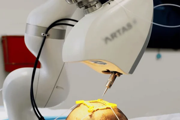 Robotergestützte Haartransplantation – Ist die klassische FUE-Methode besser?