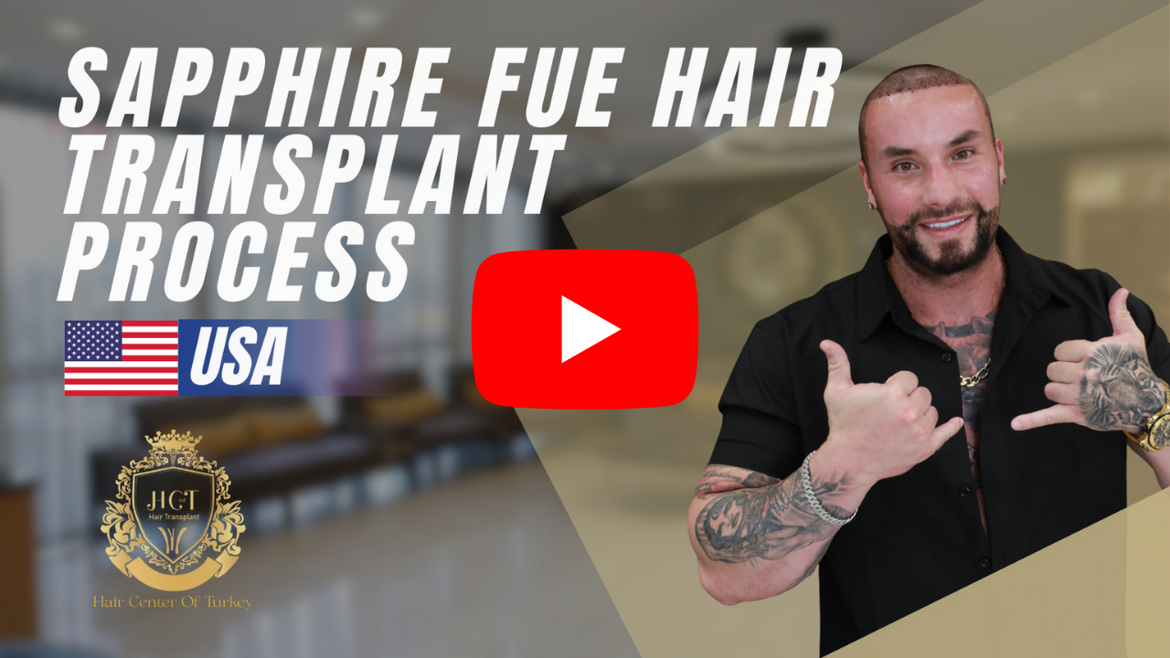 mpcopy 29 sapphire fue hair transplant process hair transplant journey th