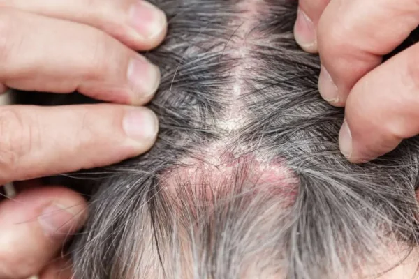 O que causa crostas no couro cabeludo?