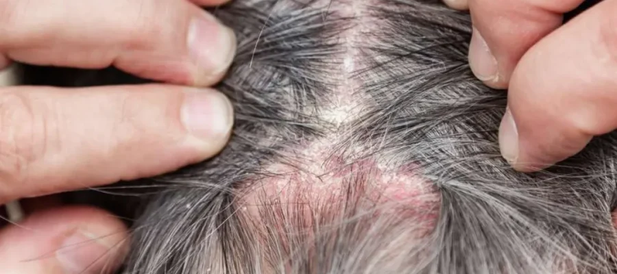 What Causes Scabs on the Scalp? 1 scabs on scalp