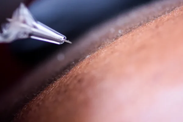 Micropigmentação do couro cabeludo