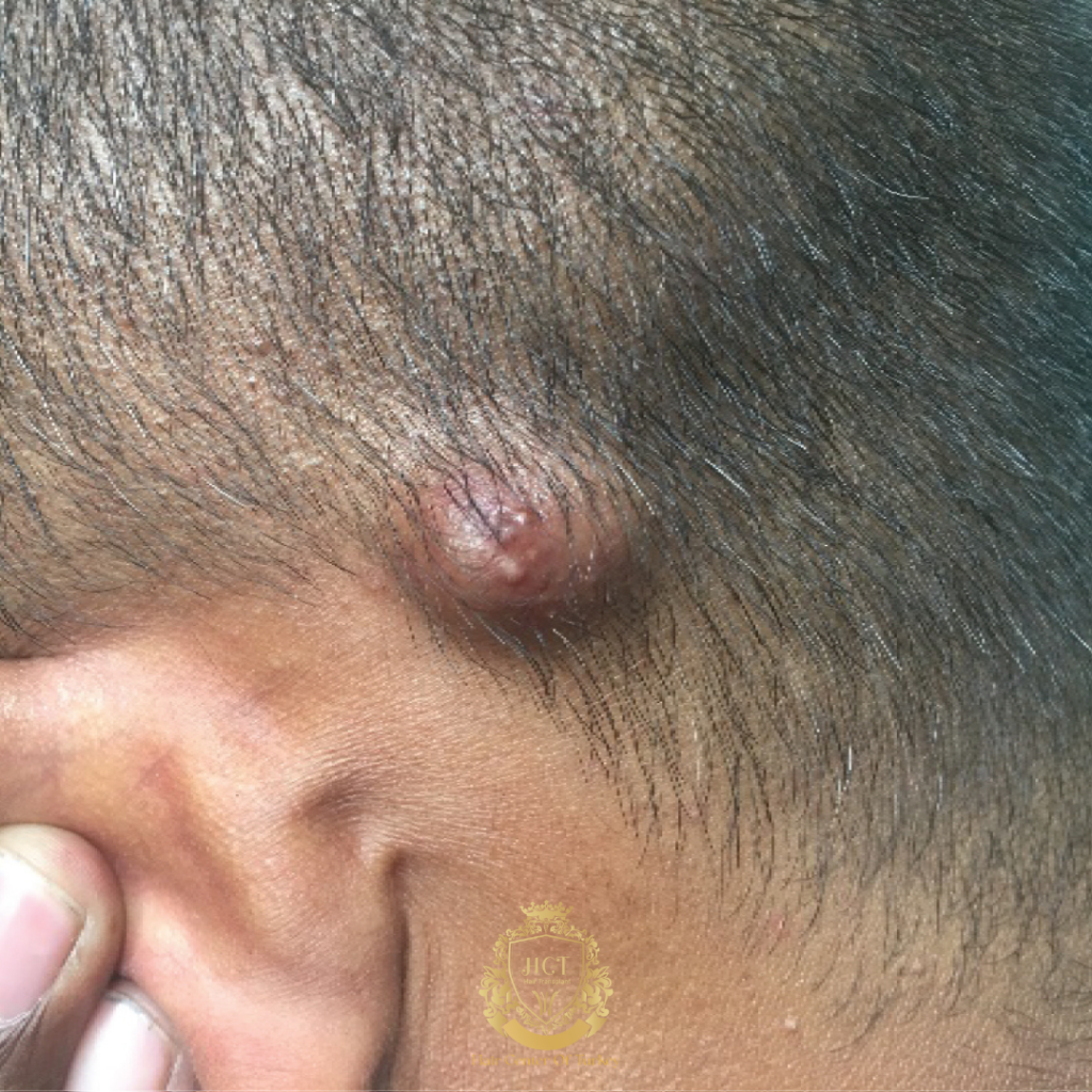 tumor no couro cabeludo