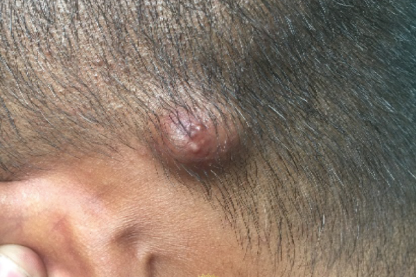 Tumores do couro cabeludo